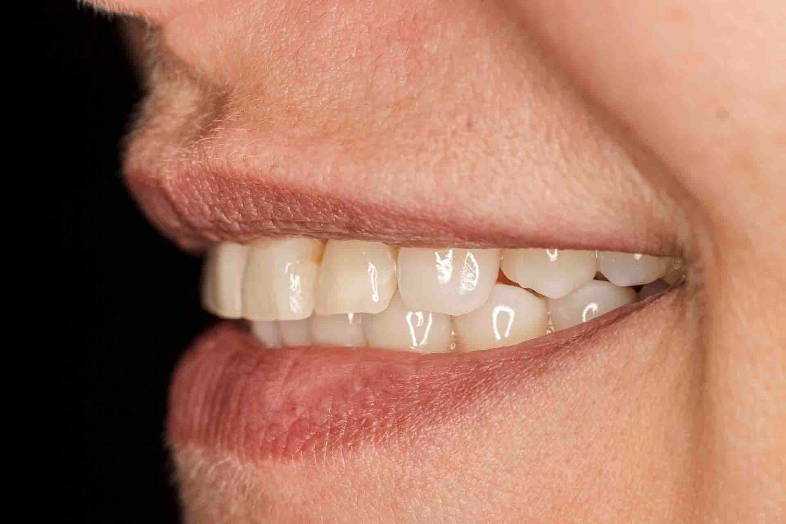 Bruxismo do sono - saiba como evitar as dores e desgastes dos dentes