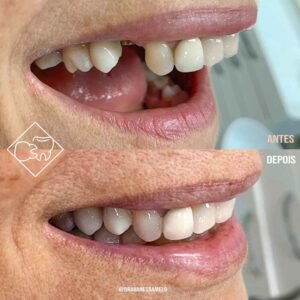 Antes e depois, acima a foto da boca de uma senhora sem um dente e abaixo a foto no mesmo enquadramento com o implante perfeito onde nao havia dente.