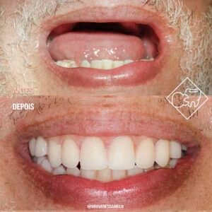 Antes e depois, acima a foto da boca de um senhor sem dentes na parte superior e abaixo a foto no mesmo enquadramento com o implante superior completo e sorriso perfeito.