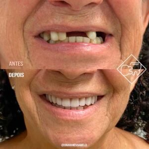 Antes e depois, acima a foto da boca de uma senhora com apenas quatro dentes na parte superior e abaixo a foto no mesmo enquadramento com o implante superior completo e sorriso perfeito.