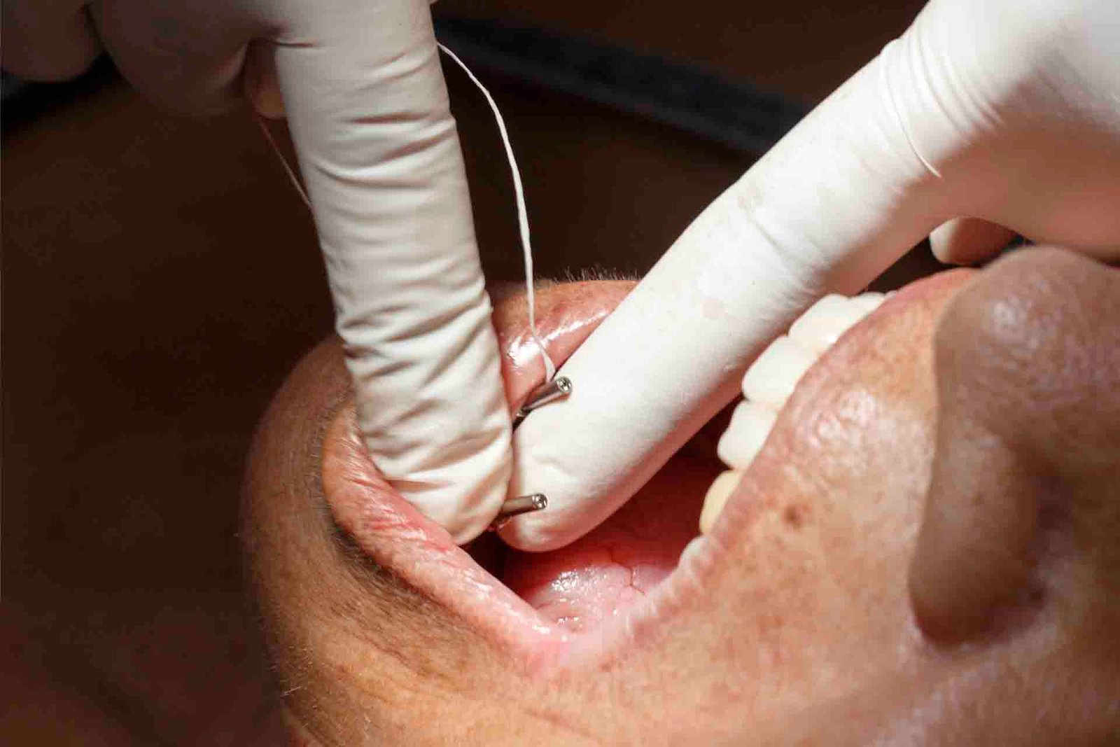Plano fechado, detalhe nos dedos da Dra. Vanessa Melo Bucomaxilofacial fixando os pinos do implante na boca aberta da paciente.